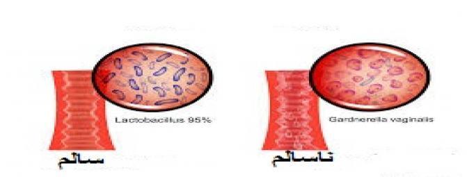 مهمترین علایم عفونت باکتریایی واژن (BV)